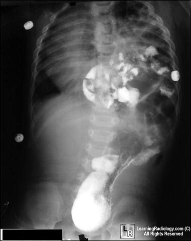 Cong Absence Diaphragm